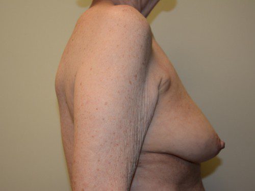 Breast Reconstruction Tissue Expanders Before Patient 5