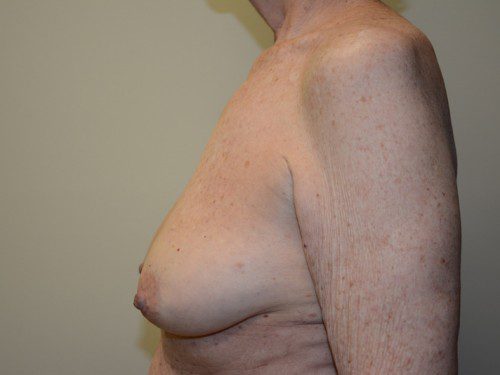 Breast Reconstruction Tissue Expanders Before Patient 3