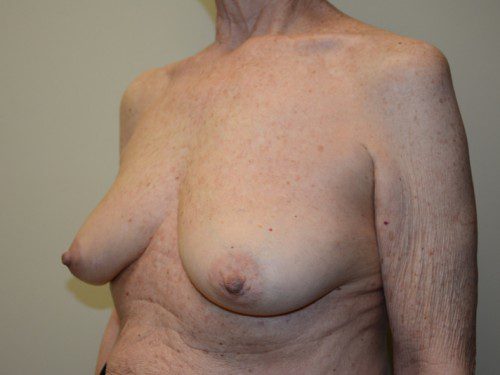 Breast Reconstruction Tissue Expanders Before Patient 2