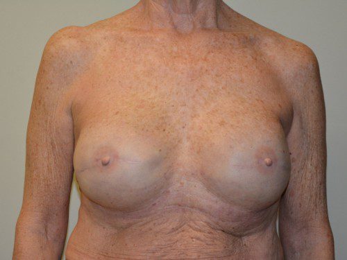 Breast Reconstruction Tissue Expanders After Patient 1