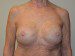 Breast Reconstruction Tissue Expanders After Patient Thumbnail 1
