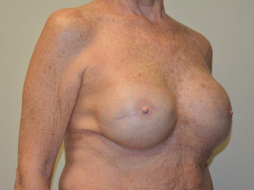 Breast Reconstruction Tissue Expanders After Patient 4