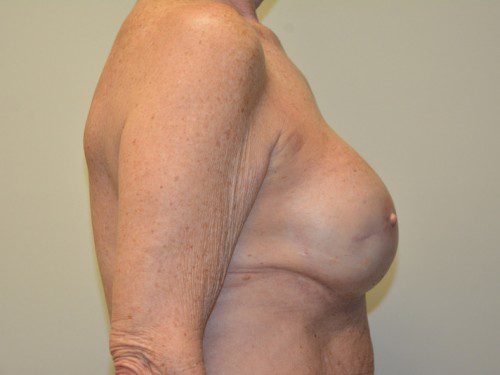 Breast Reconstruction Tissue Expanders After Patient 5