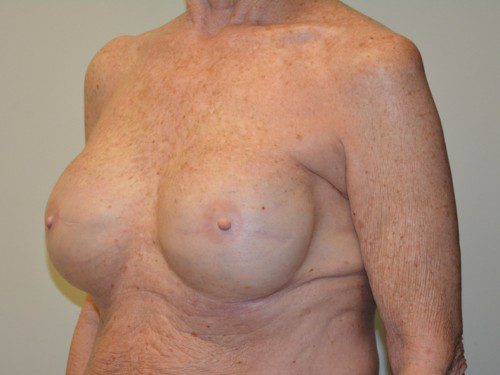 Breast Reconstruction Tissue Expanders After Patient 2