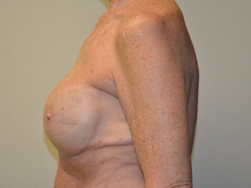 Breast Reconstruction Tissue Expanders After Patient 3