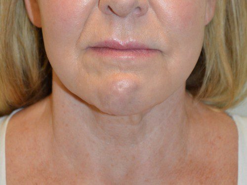 Facelift Before Patient 1