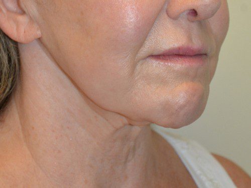 Facelift Before Patient 2