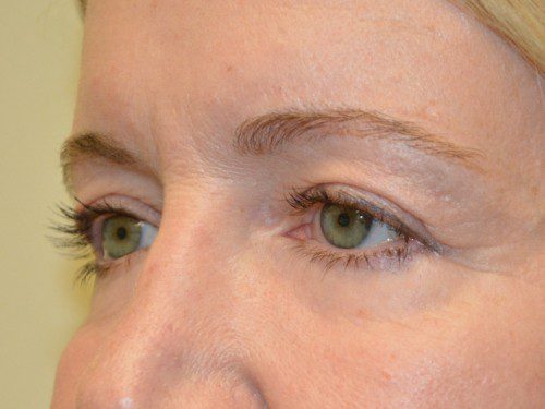 Eyelid Surgery Before Patient 2