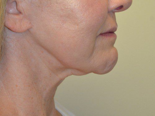 Facelift Before Patient 3