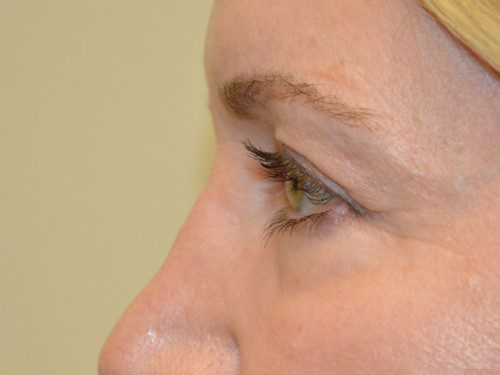 Eyelid Surgery Before Patient 3