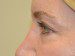 Eyelid Surgery Before Patient Thumbnail 3