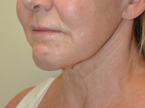 Facelift Before Patient 4