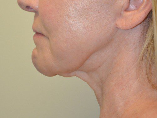 Facelift Before Patient 5
