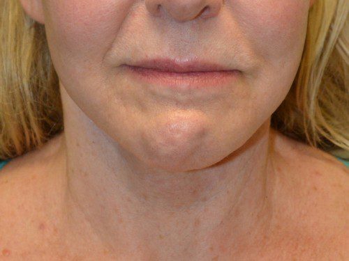 Facelift After Patient 1