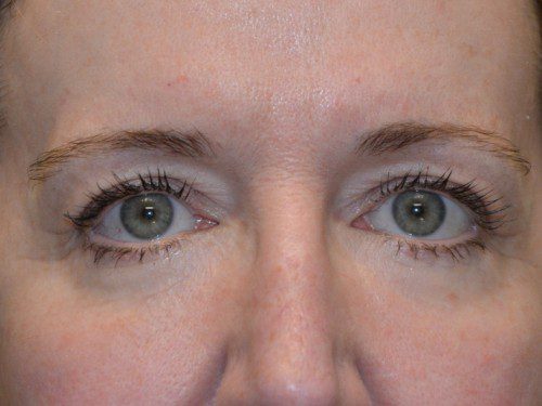 Eyelid Surgery After Patient 1