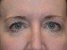 Eyelid Surgery After Patient Thumbnail 1