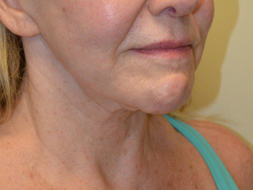 Facelift After Patient 2