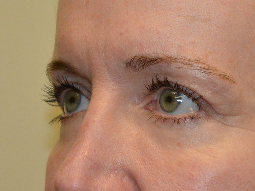 Eyelid Surgery After Patient 2