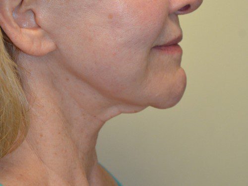 Facelift After Patient 3