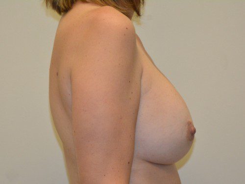 Breast Revision After Patient 3