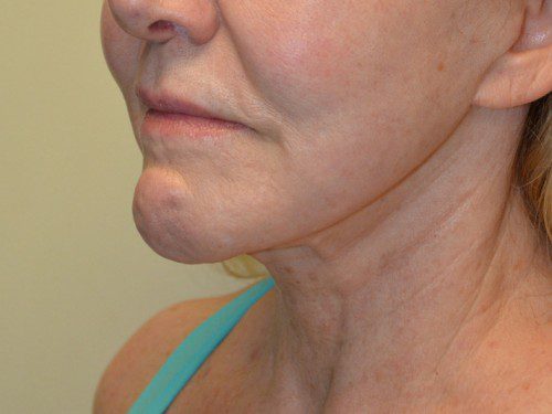 Facelift After Patient 4