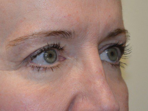 Eyelid Surgery After Patient 4