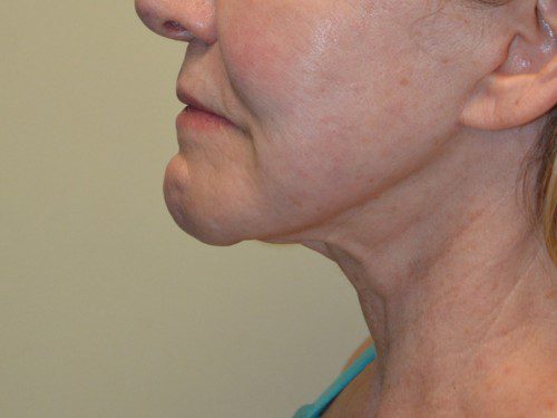 Facelift After Patient 5