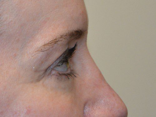 Eyelid Surgery After Patient 5