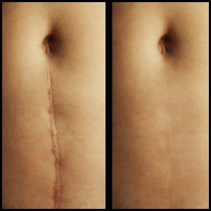 scar revision treatment