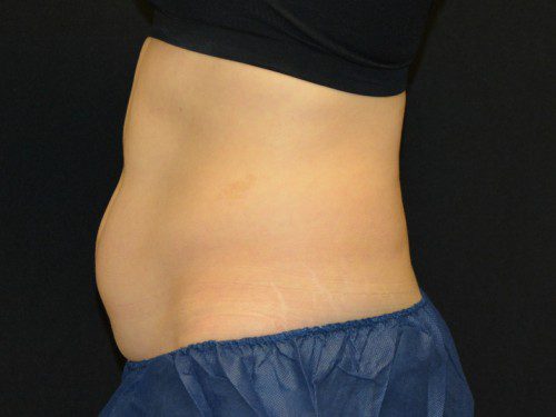 Coolsculpting Before Patient 1