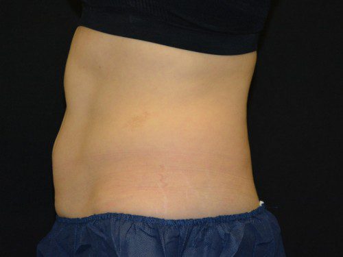 Coolsculpting After Patient 1