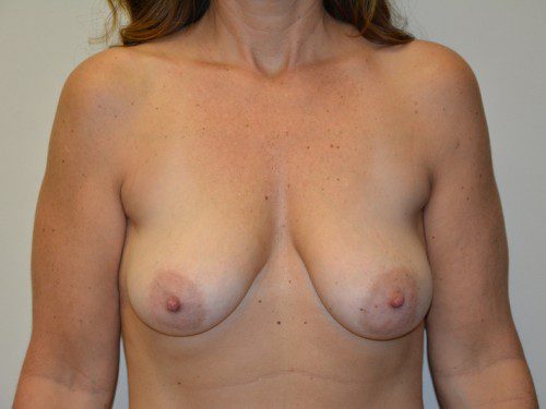 Breast Augmentation w/Lift Before Patient 1