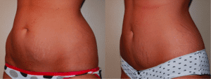 Body Contouring with Liposuction