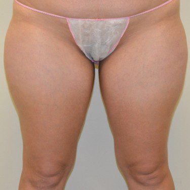 Liposuction Before Patient 1