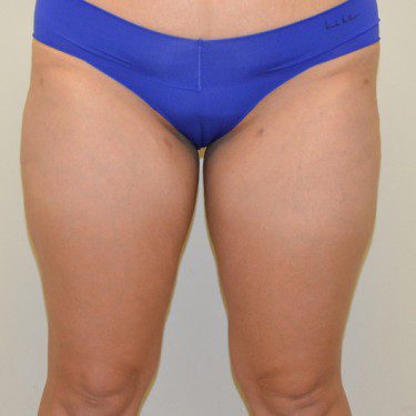 Liposuction After Patient 1