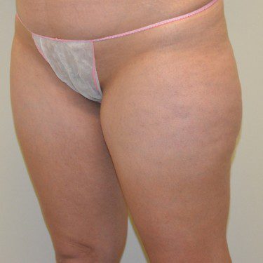 Liposuction Before Patient 2