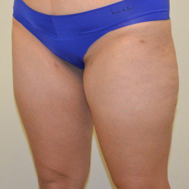 Liposuction After Patient 2