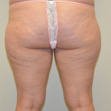 Liposuction Before Patient 3