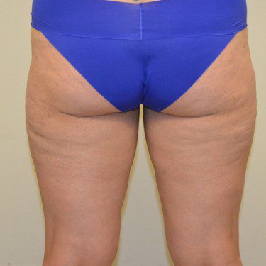 Liposuction After Patient 3