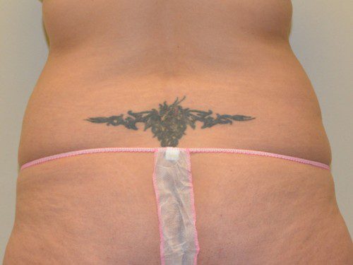 Liposuction Before Patient 1