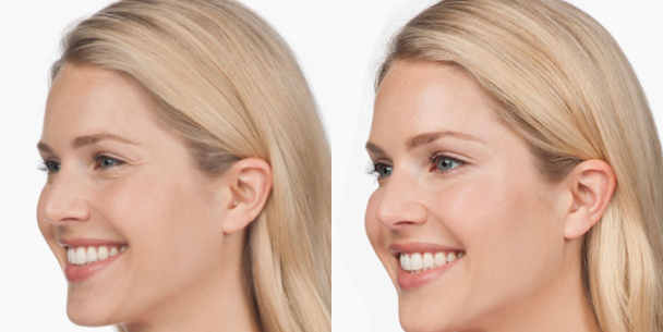 BOTOX® Cosmetic Before & After Photos