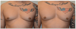 Gynecomastia Surgery Before and After Photos