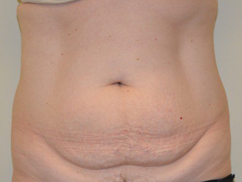 Tummy Tuck Before Patient 1