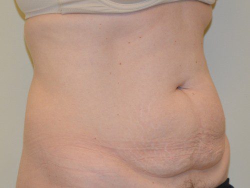Tummy Tuck Before Patient 4