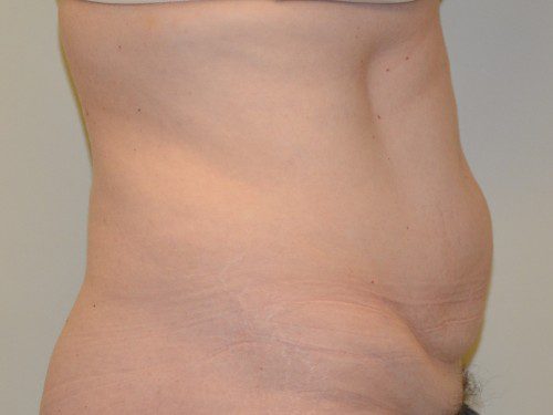 Tummy Tuck Before Patient 5