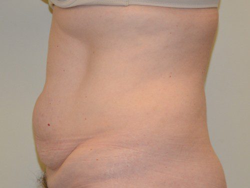 Tummy Tuck Before Patient 3