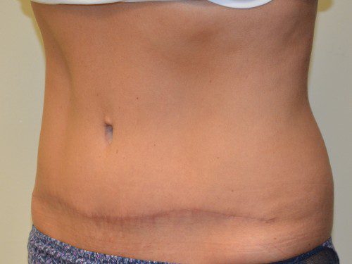 Tummy Tuck After Patient 2