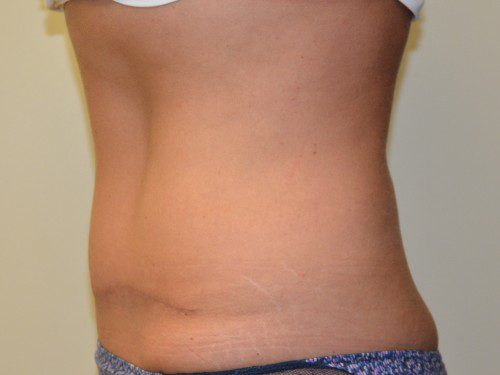 Tummy Tuck After Patient 3