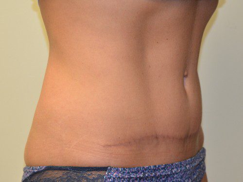 Tummy Tuck After Patient 4