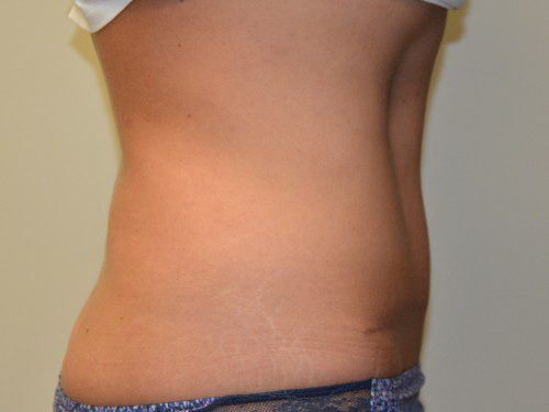 Tummy Tuck After Patient 5